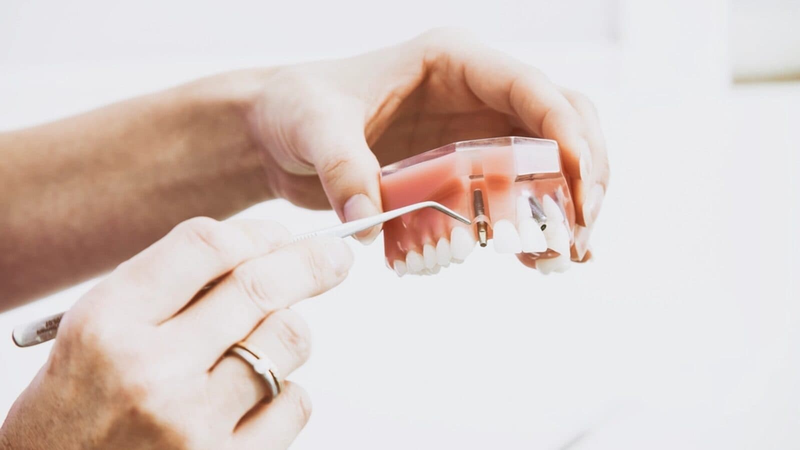 Dentist holding a dental model showing an implant and crown