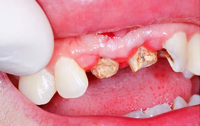 Custom dentures - before