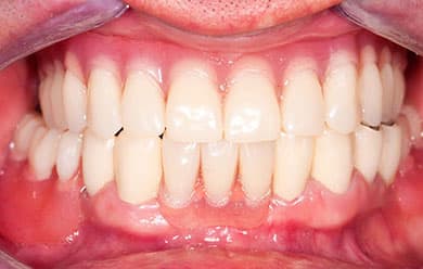 Implant restoration - after