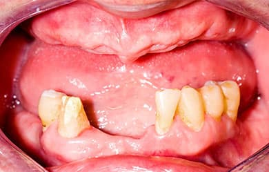 Implant restoration - before