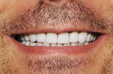 Full smile restoration - after